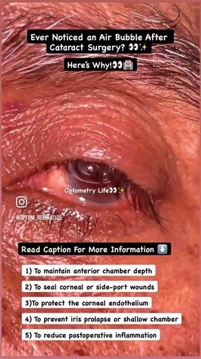 Have u ever seen Air Bubble in Post -OP Eye 👀🏥👩‍⚕️ #optocruisers #optometrist #ophthalmology #eye