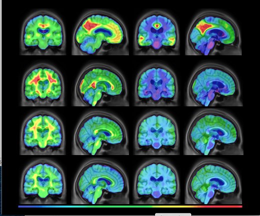 ADI - World Alzheimer Report 2021