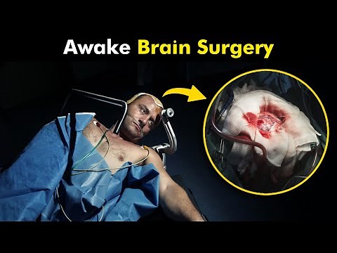 How Awake Brain Surgery is performed? | Awake Craniotomy (3D Animation)