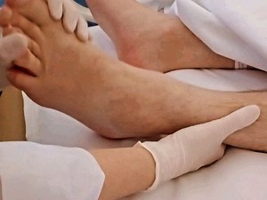 NEUROLOGIA CLINICA on Instagram: "🧠El clonus es un reflejo de estiramiento oscilante rítmico que está relacionado con lesiones de la neurona motora superior. Por tanto, el clonus suele ir acompañado de hiperreflexia. La prueba de clonus se realiza como parte del examen neurológico. 🌀Puede evaluarse en muchas articulaciones, pero se observa con mayor frecuencia en la articulación del tobillo al realizar una dorsiflexión enérgica del pie. La rápida dorsiflexión del pie del paciente estira los hu