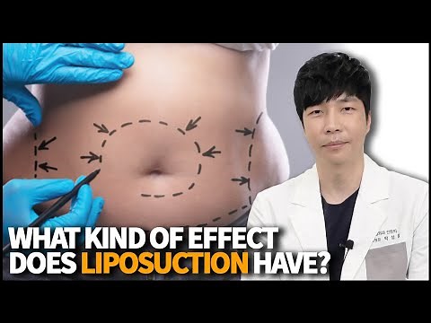 Liposuction: Everything You Need to Know with Doctor Park