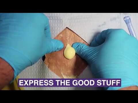 Incision and Drainage of Cutaneous Abscesses