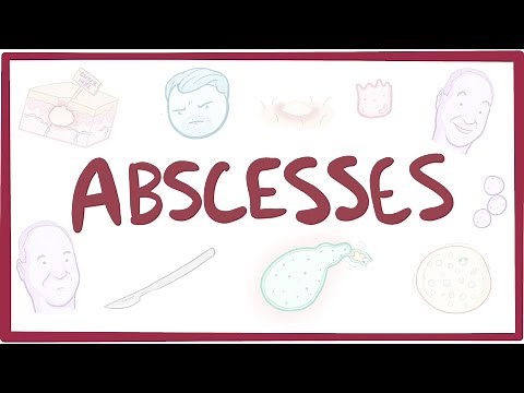 Abscesses - causes, symptoms, diagnosis, treatment, pathology