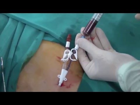 Permanent HD Cath insertion
