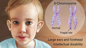 Fragile X syndrome causes, inheritance, symptoms, diagnosis & treatment