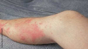 Skin rash covering lower leg. Poison sumac reaction resulting in itchy red welts and sores caused by chemical urushiol, found in poison oak and poison ivy as well. Slow camera pan.
