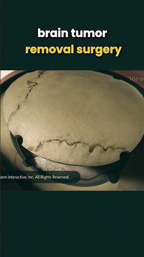 brain tumor surgery/brain tumor removal explained/ neurosurgery