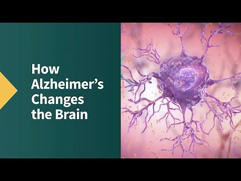 How Alzheimer's Changes the Brain