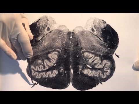 Brain Stem & Reflexes: Neuroanatomy Video Lab - Brain Dissections