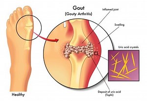 Gout: Causes, Symptoms, Treatment, Home remedies