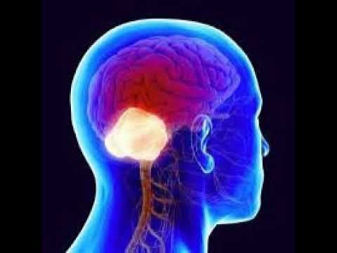 Podcast # 485: Cerebellar Stroke