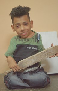 My bones are incredibly fragile | Born Different