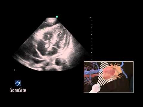 How To: Ultrasound Guided Pericardiocentesis Procedure 3D Video