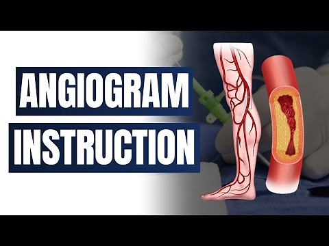Everything you need to know about angiograms and what to expect after