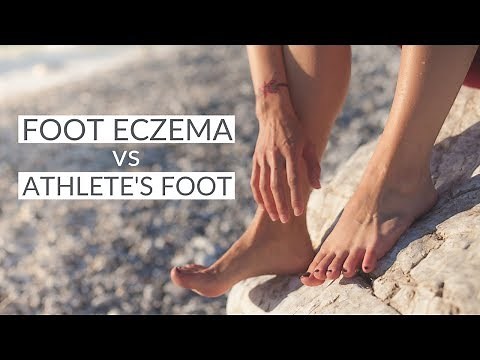 The Difference Between Foot Eczema and Athelete's Foot | How to Treat Foot Eczema Naturally