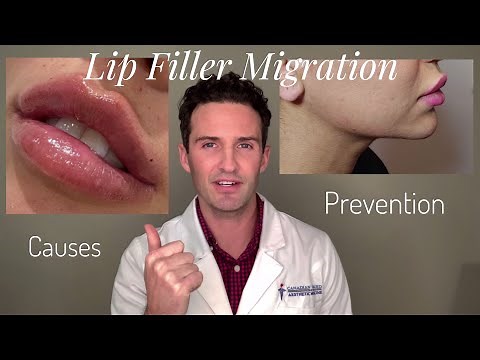Lip Filler Migration: Causes & Prevention