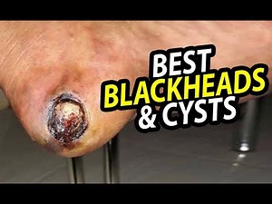 Largest Blackheads & Cysts - World's Greatest Medical