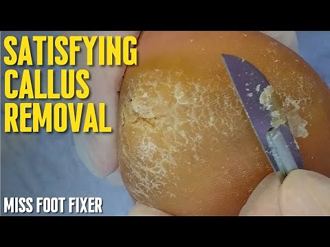 Satisfying Callus Removal From Feet | Callus Removal From Feet With Blade By Miss Foot Fixer