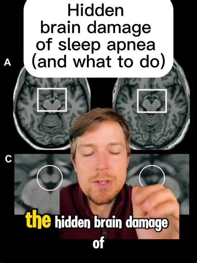 The hidden brain damage from sleep apnea is worse than you think. (Tap @apneareset to get your clear, personalized path to better sleep) Brain scans tell the story clearly: people with sleep apnea show visible brain injury — even in the regions that control breathing itself. The mammillary bodies, the hippocampus, and other key memory and cognition centers all take hits. That’s why many people with untreated apnea feel foggy, forgetful, or “slowed down,” even if they think they slept long enough