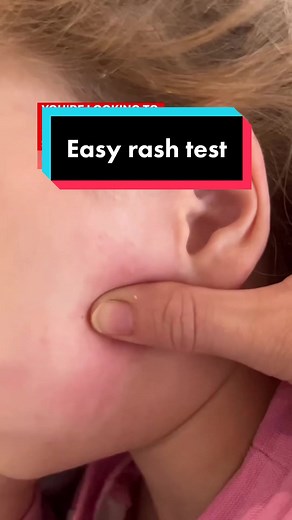 Simple way to check if a rash is serious of not 🙌 Blanching aka changes colour when pressed = good, keep an eye out for any other worrying signs or symptoms Non-blanching aka colour does not change when pressed = bad, see a doctor urgently these types of rashes can be associated with serious illness (not always though) like meningococcal so act quickly! If your nor sure if it changed colour film in slow motion like I did this one and review or use a glass and roll it over the top! PS. This is m