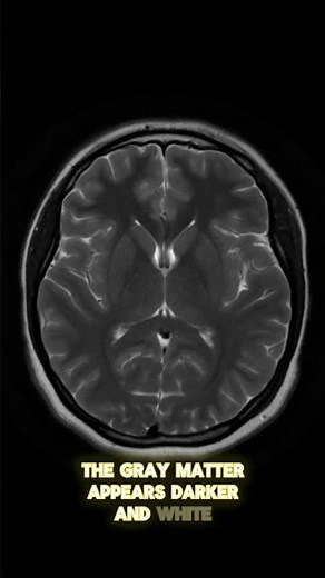 Understanding Your MRI: The Brain Explained