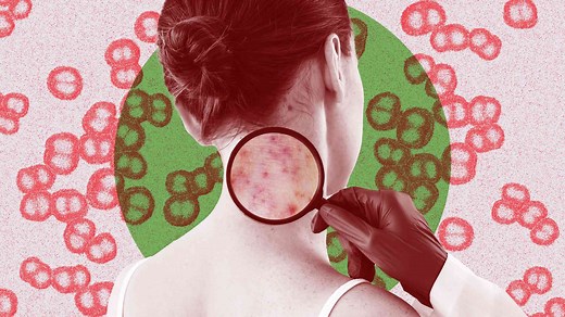 How To Identify a Meningitis Rash (Using a Glass)