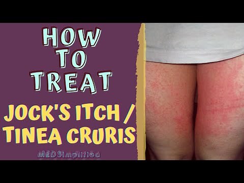 HOW TO TREAT JOCK'S ITCH / TINEA CRURIS