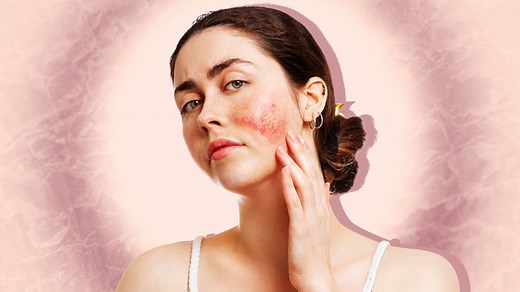 Facial Atopic Dermatitis: How to Spot It, Treat It, and What To Do About It