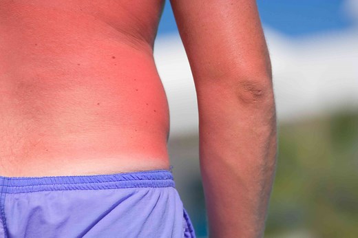 How You Can Identify and Heal Sun Blisters
