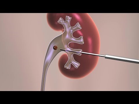 Percutaneous Nephrolithotomy